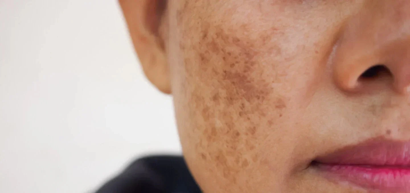 Close-up of a face with freckles and uneven skin tone